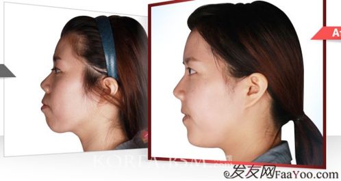 做完嘴巴整形的注意事項,整容注意事項容注意事項,整容合同注意事項