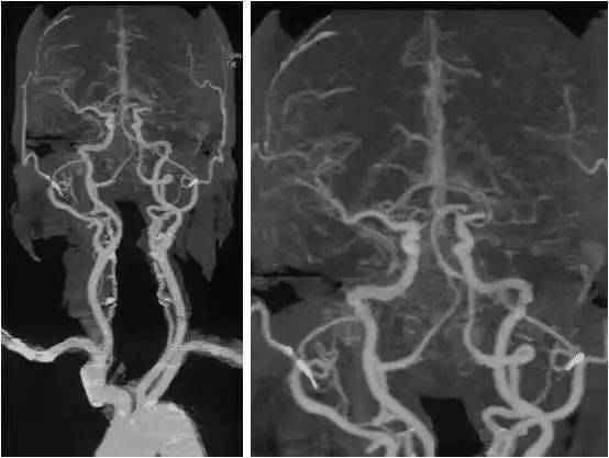 mra注意事項(xiàng)