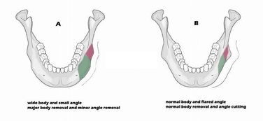 手術(shù)后,注意事項
