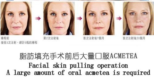 下巴,填充,注意事項,自體