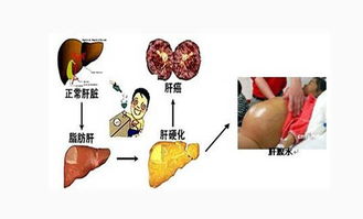 肝硬化,注意事項,患者,飲食