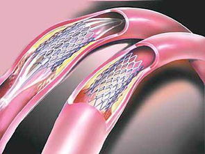 支架術前術后注意事項,冠脈支架術后的注意事項,冠脈支架植入術后注意事項