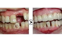 全鋯鑲牙注意事項(xiàng)