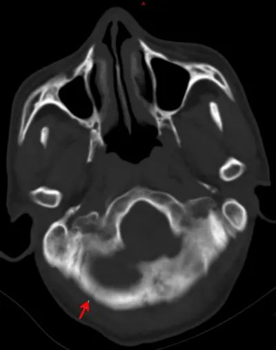 頭顱ct需要注意事項(xiàng)