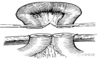 結(jié)腸灌洗術(shù)注意事項(xiàng)