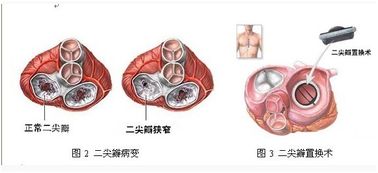 風(fēng)濕性心臟病介入冶療后注意事項