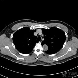 神經(jīng)鞘瘤術(shù)后注意事項