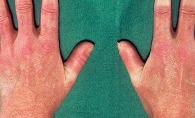 局限性硬皮病注意事項(xiàng),硬皮病生活注意事項(xiàng),硬皮病的麻醉注意事項(xiàng)