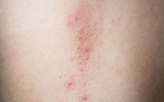 玫瑰康疹注意事項